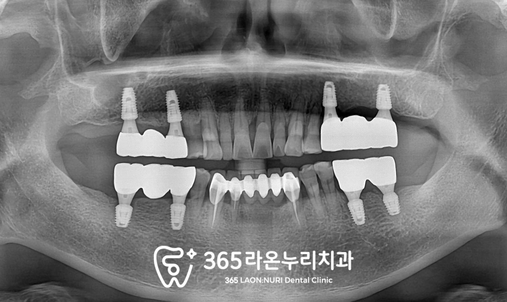 좌우 단 두 번만에 어금니 임플란트